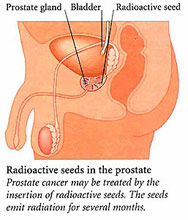 Prostate cancer